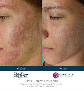 SkinPen