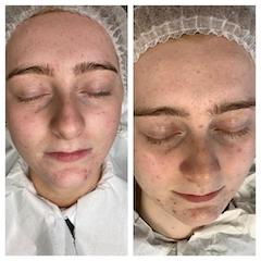 Hydrafacial and Microneedling with the homecare clinicare range